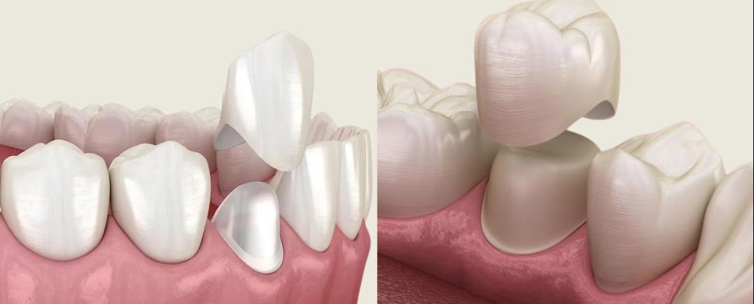 Ilustrație: coroană dentară aplicată pe un dinte