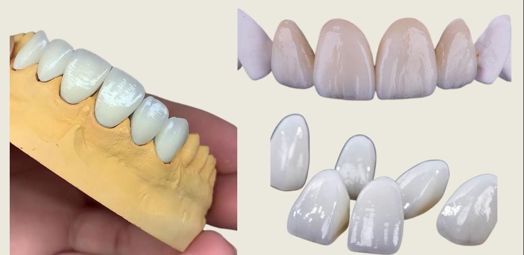 Fațete dentare ceramice, pe model și separat